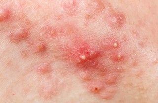 Cystic Acne