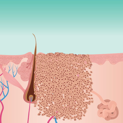 Illustration of skin tissue showing a verruca