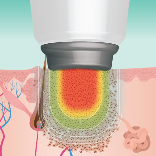 Illustration of a verruca being treated with Swift micrrowave therapy