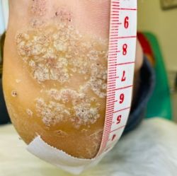 Before: The heal of a foot with verrucae